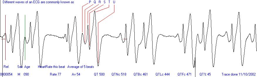 Easy ECG heart trace