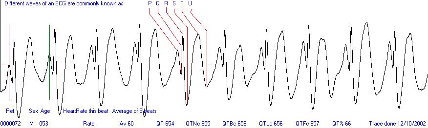 Easy ECG heart trace