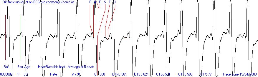 Easy ECG heart trace