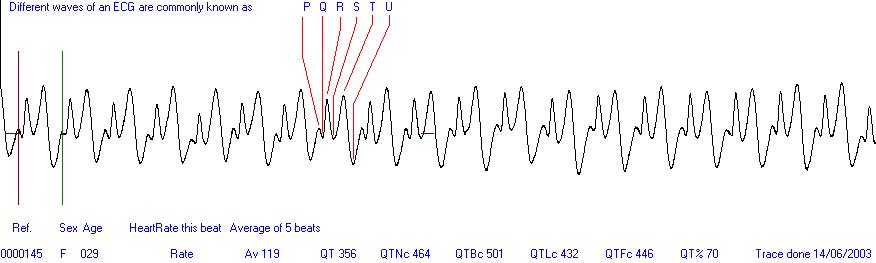 Easy ECG heart trace