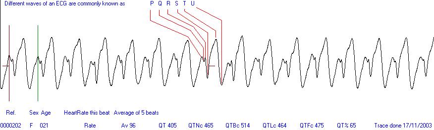 Easy ECG heart trace