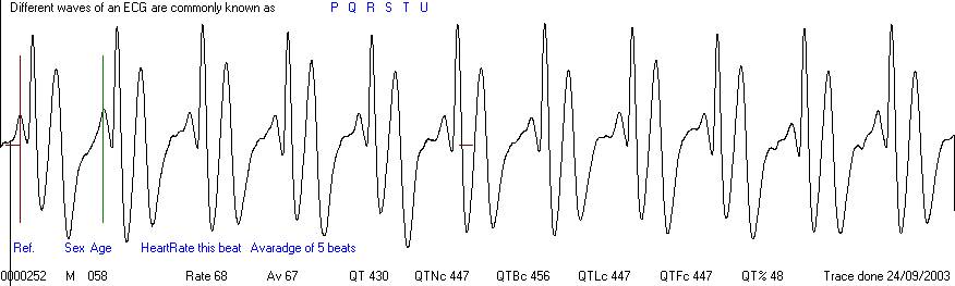 Easy ECG heart trace