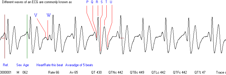 Easy ECG heart trace